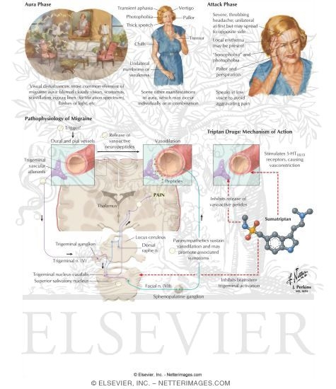 Watermarked preview of labeled image: Sumatriptans and Reuptake Inhibitors