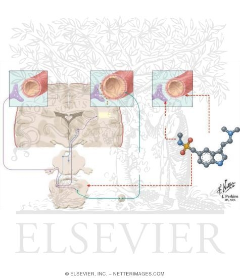 Watermarked preview of unlabeled image: Pathophysiology of Migraine