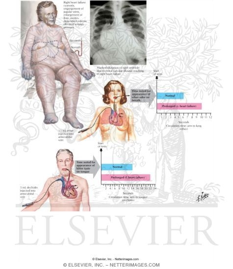 Watermarked preview of labeled image: Heart Failure Overview