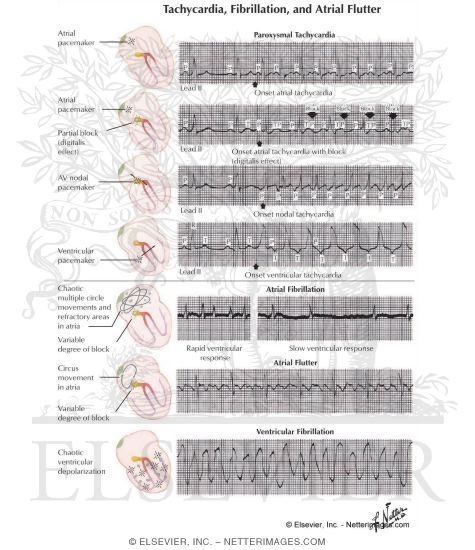 Watermarked preview of labeled image: Tachycardia, Fibrillation, and Atrial Flutter