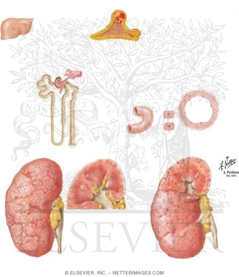 Watermarked preview of unlabeled image: Hypertension Treatment: Diuretics