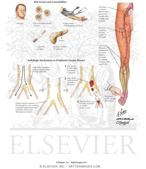 Watermarked preview of labeled image: Peripheral Vascular Disease
