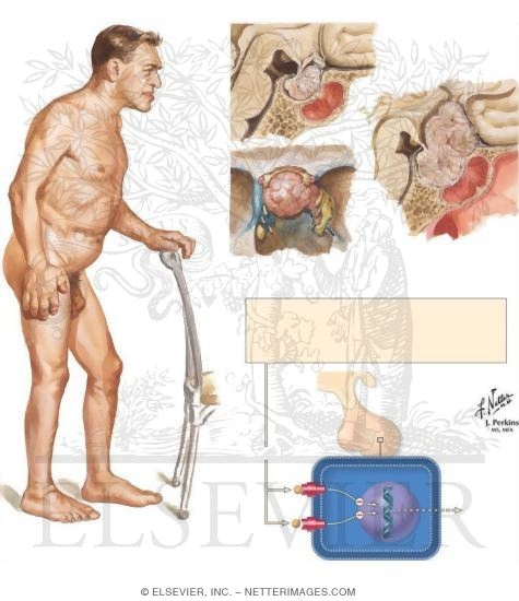Watermarked preview of unlabeled image: Growth Hormone Excess (Acromegaly) and Treatment