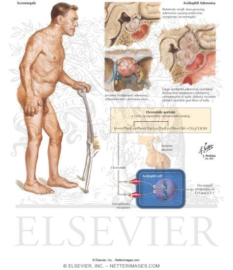 Watermarked preview of labeled image: Growth Hormone Excess (Acromegaly) and Treatment