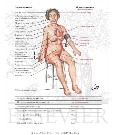 Primary and Secondary Adult Myxedema
Hypothyroidism