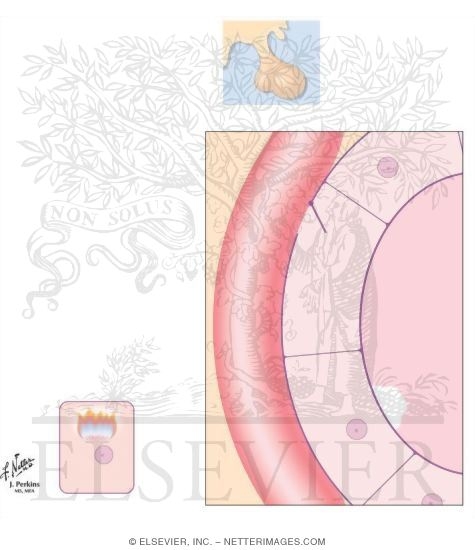 Watermarked preview of unlabeled image: Hypothyroidism: Treatment of Choice
