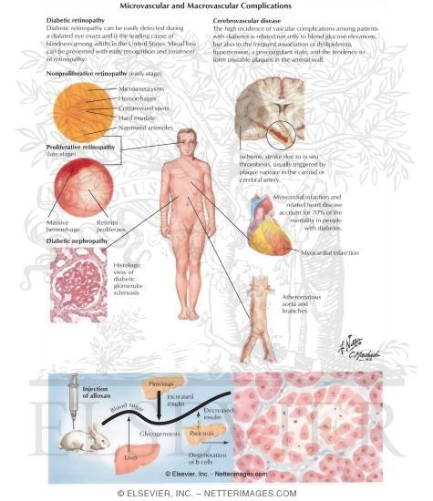 Type 1 Diabetes Mellitus