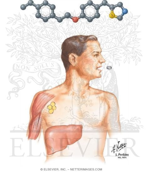 Thiazolidinediones