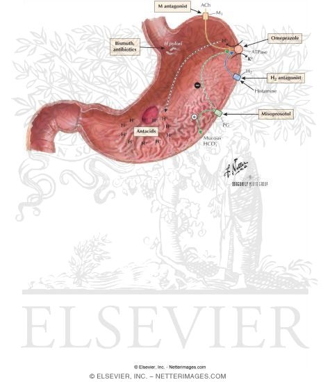 Watermarked preview of labeled image: Peptic Ulcer Disease