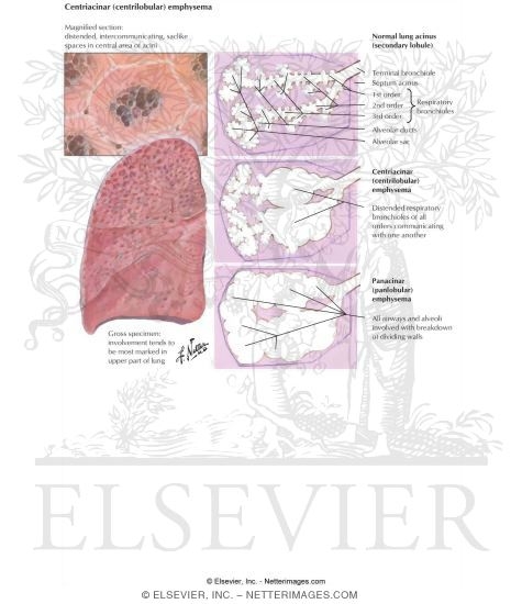 Watermarked preview of labeled image: Emphysema