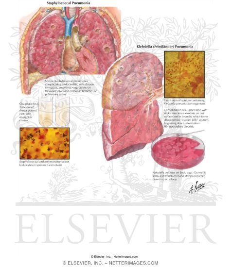 Watermarked preview of labeled image: Bacterial Pneumonia