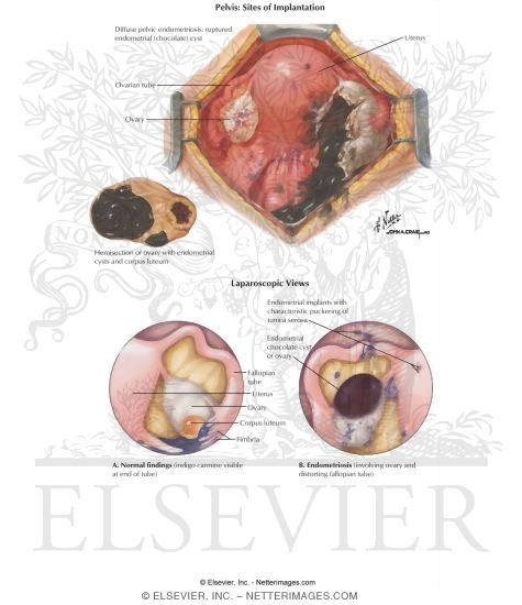 Watermarked preview of labeled image: Endometriosis