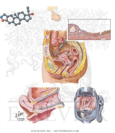 Danazol As Treatment for Endometriosis