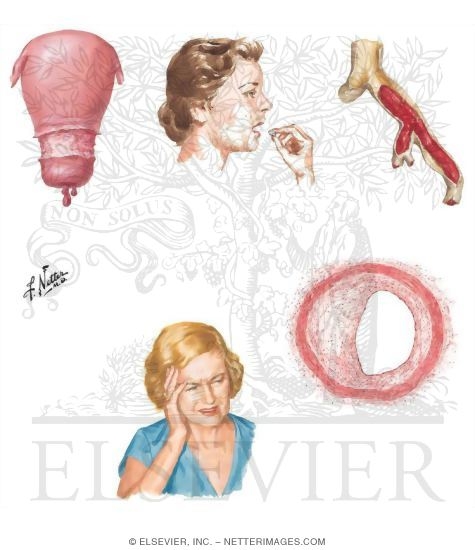 Watermarked preview of unlabeled image: General Adverse Effects of Hormone Replacement Therapy (HRT)