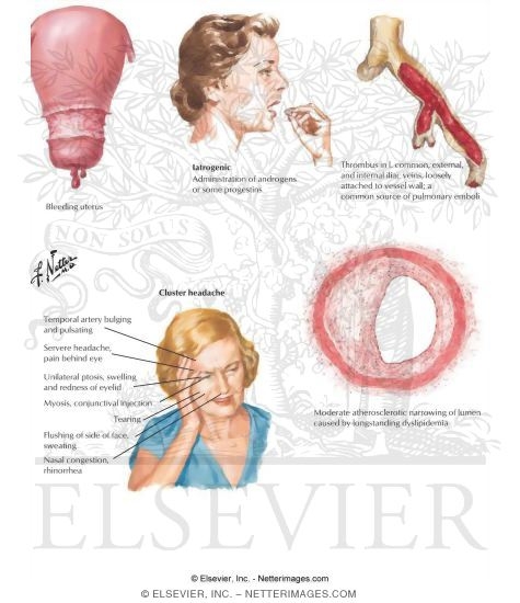 Watermarked preview of labeled image: General Adverse Effects of Hormone Replacement Therapy (HRT)