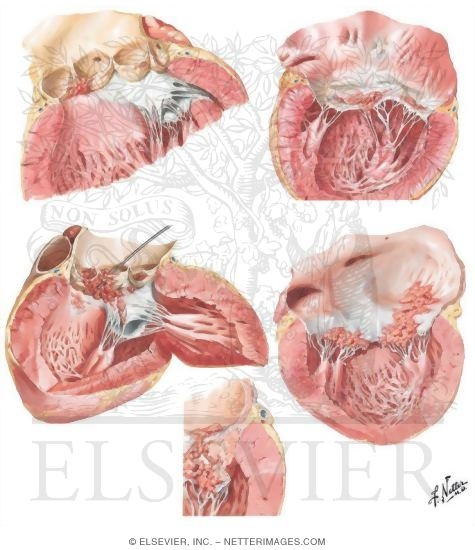 Watermarked preview of unlabeled image: Vancomycin Used for Endocarditis