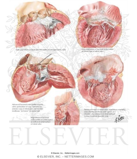 Watermarked preview of labeled image: Vancomycin Used for Endocarditis
