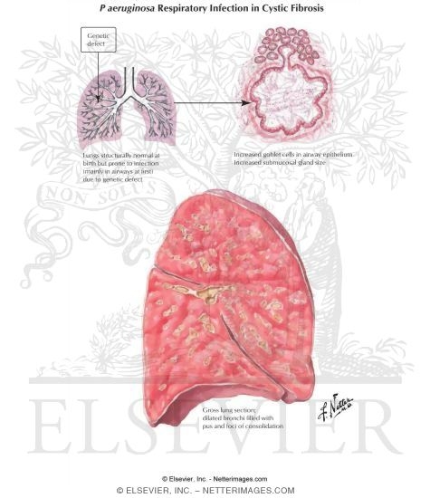 Watermarked preview of labeled image: Cystic Fibrosis of the Pancreas