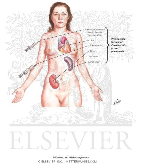 Watermarked preview of labeled image: Pneumocystis Carinii Pneumonia