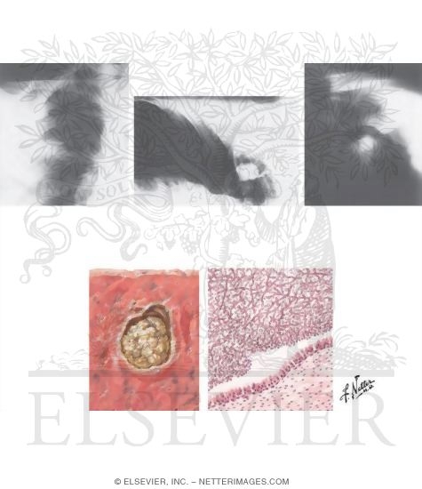 Watermarked preview of unlabeled image: Aspergillosis