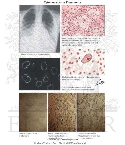 Watermarked preview of labeled image: Cytomegalovirus Pneumonia