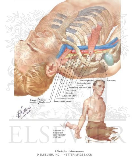 Watermarked preview of labeled image: Neurovascular Syndromes of the Shoulder Girdle