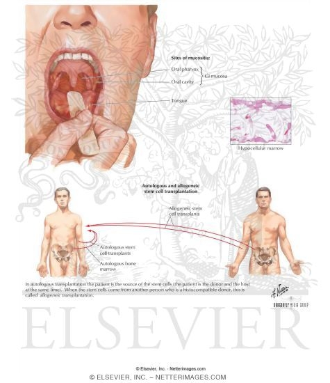 Watermarked preview of labeled image: Adverse Effects of Chemotherapy