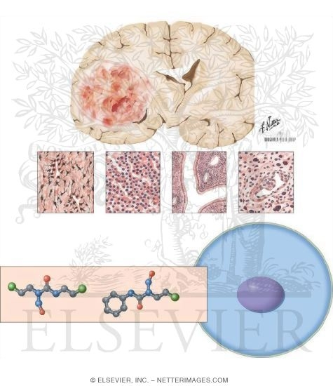 Nitrosoureas: Carmustine and Lomustine