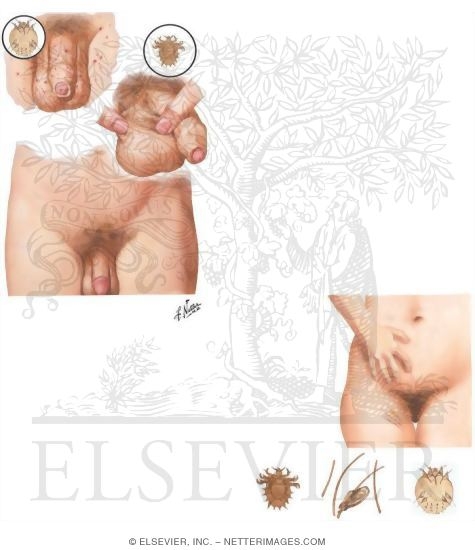 Scabies and Pediculosis