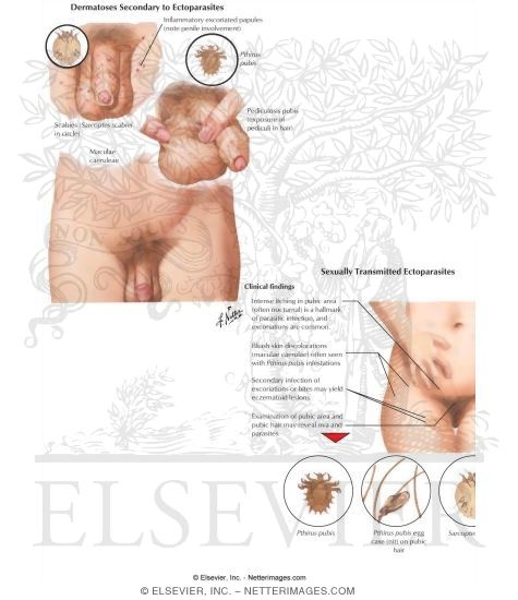 Watermarked preview of labeled image: Scabies and Pediculosis