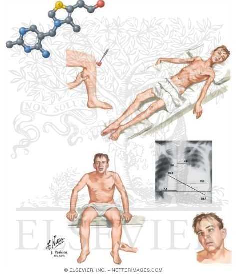 Watermarked preview of unlabeled image: Deficiency of Thiamine (B1) and Other B Vitamins
