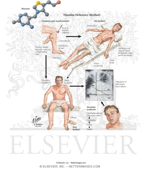 Watermarked preview of labeled image: Deficiency of Thiamine (B1) and Other B Vitamins