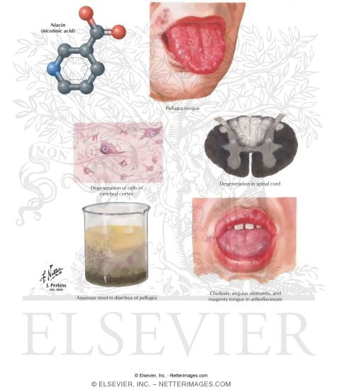 Watermarked preview of labeled image: Niacin Or Nicotinic Acid Deficiency (Pellagra)