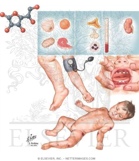 Watermarked preview of unlabeled image: Vitamin C Deficiency (Scurvy)