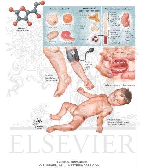 Vitamin C Deficiency (Scurvy)