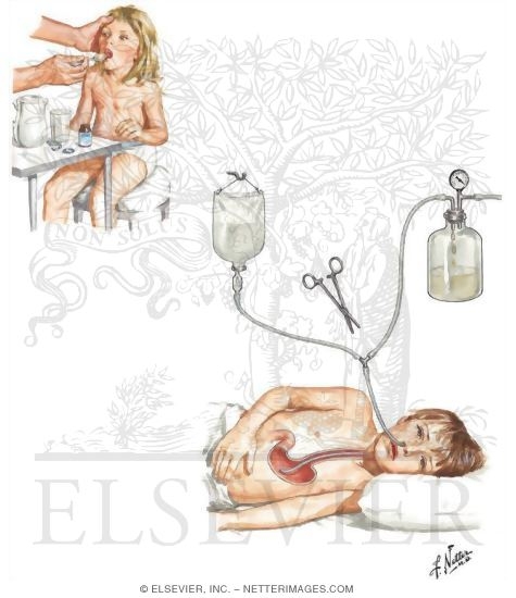 Watermarked preview of unlabeled image: Management of Poisoning and Overdose