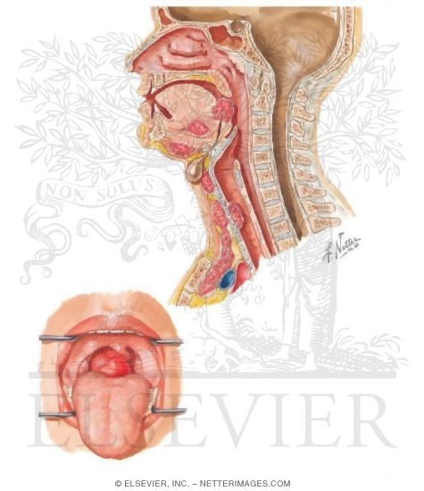 Pharyngeal Pouch Abnormalities: Ectopic Thyroid
