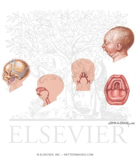 Pharyngeal Arch Abnormalities: Pierre Robin