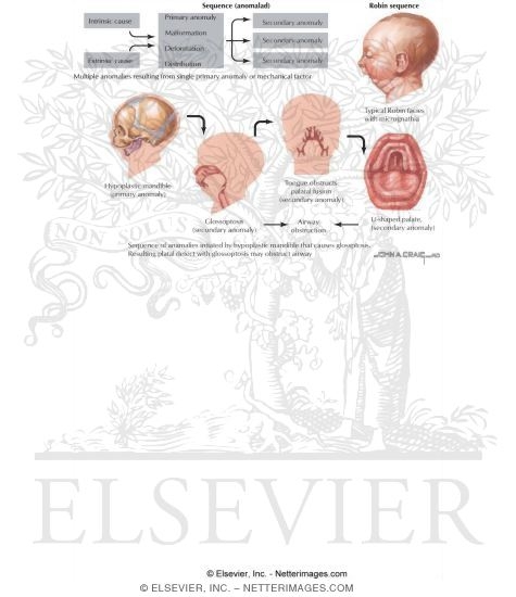 Pharyngeal Arch Abnormalities: Pierre Robin