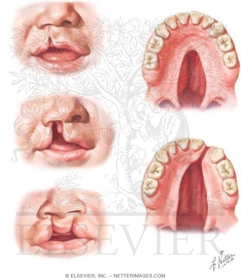 Cleft Lip and Palate