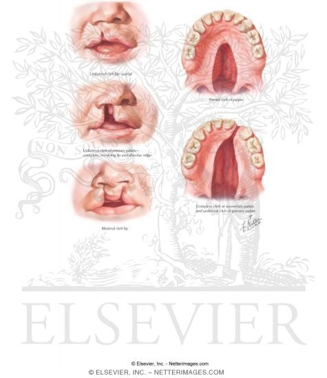 Cleft Lip and Palate