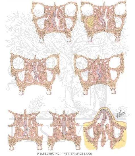 Types of Deviated Septum