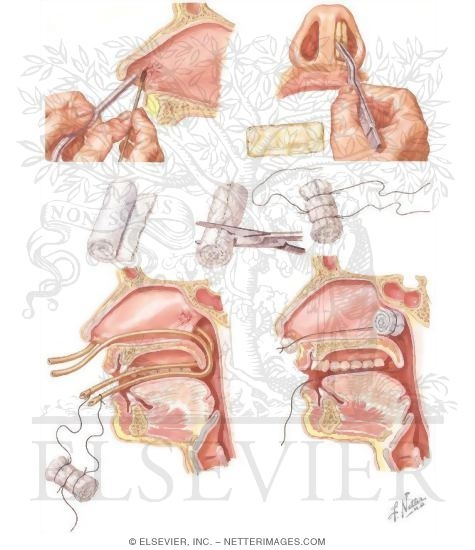 Nasal Bleeding