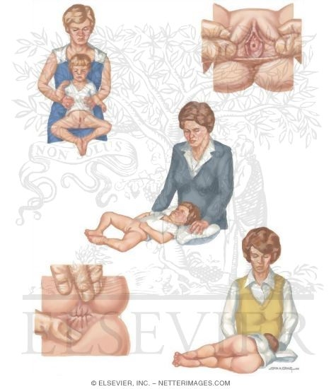 pediatric genital exam Child Abuse: Genital Examination