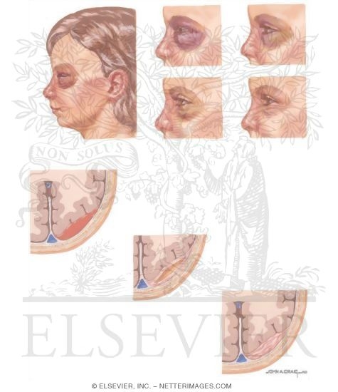 Watermarked preview of unlabeled image: Child Abuse: Staging of Injuries