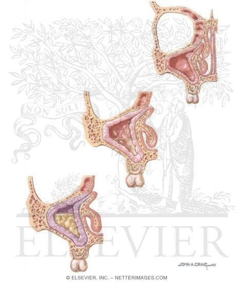Watermarked preview of unlabeled image: Pathogenesis of Sinusitis