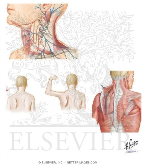 Watermarked preview of unlabeled image: Lesions Affecting the Spinal Accessory Nerve