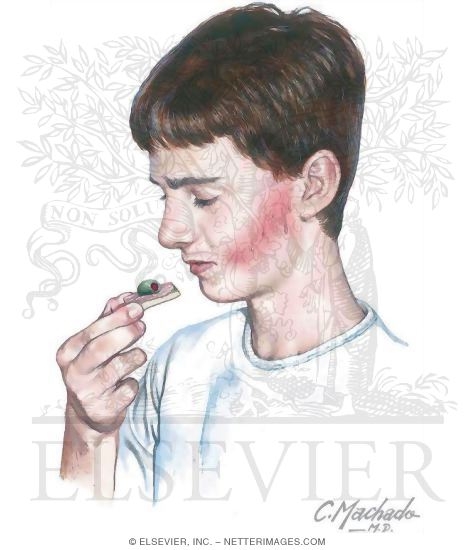 Frey's Syndrome