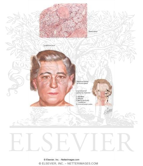 Watermarked preview of labeled image: Tumors of the Parotid Gland