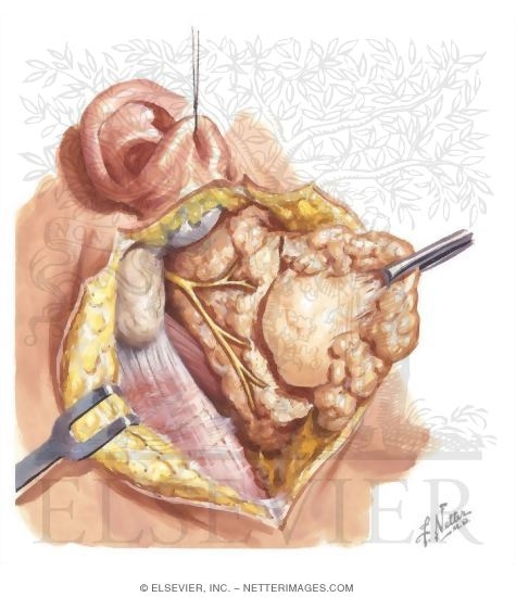 Watermarked preview of unlabeled image: Tumors of the Parotid Gland